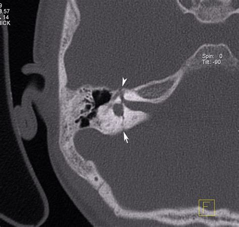 Radiodiagnosis - Imaging is Amazing-Interesting cases: Temporal bone fracture with facial nerve ...