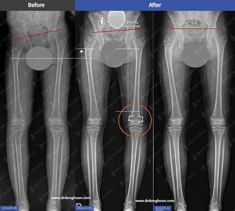 Leg Length Discrepancy Treatment