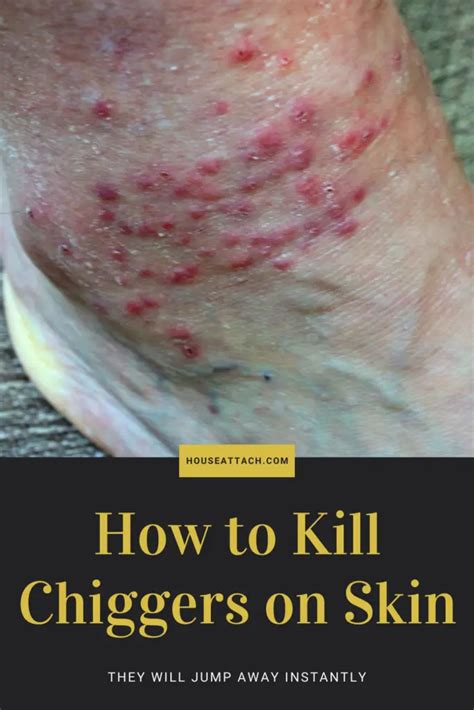 How to Get Rid of Chiggers