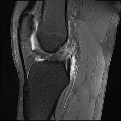 Cureus | Seeing Double: A Case of ACL Tears in Monozygotic Twin Female ...