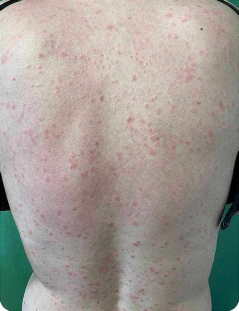 A Disseminated Rash on the Upper Body | AAFP