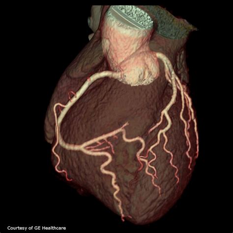 WHAT DOES CARDIAC CT SHOW? • MyHeart