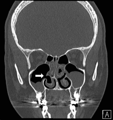 Pneumatized Inferior Turbinate: A Report of Three Cases | Cureus