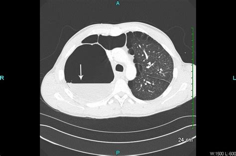 Bullous Lung Disease - The Western Journal of Emergency Medicine