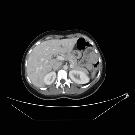 Hypoglycemia MRI - wikidoc