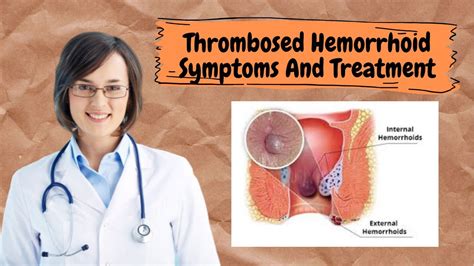 Thrombosed Hemorrhoid Symptoms And Treatment - Easy Ways To Get Rid Of Hemorrhoids - YouTube