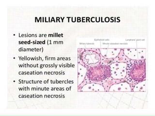 Miliary tuberculosis | PPT