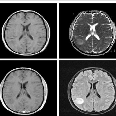 CT brain: focal cortical thickening in right posterior parietal lobe | Download Scientific Diagram