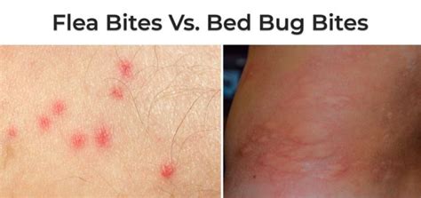 Flea Bites vs. Bed Bug Bites: Different Symptoms, Treatments ...