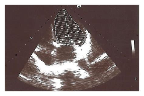 Transthoracic echocardiography revealed global hypokinesia of the LV... | Download Scientific ...