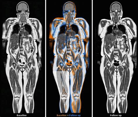 Full Body MRI Scan