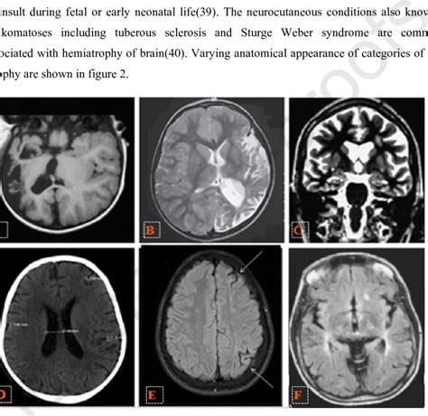 TYPES OF BRAIN ATROPHY. | Download Scientific Diagram