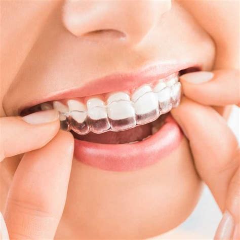 Book An Invisalign Invisible Braces Consultation at DentoBeauty, Grays, Essex