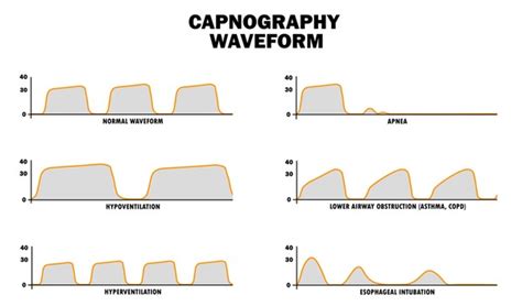 52 Capnography Royalty-Free Photos and Stock Images | Shutterstock