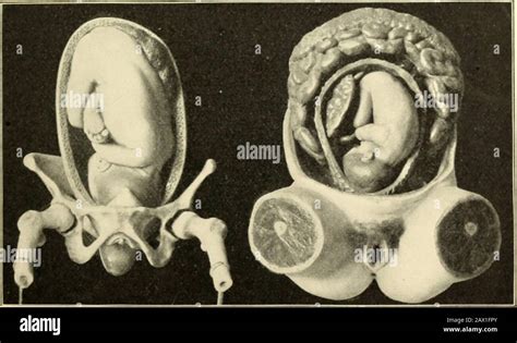 Fetal skull fontanels hi-res stock photography and images - Alamy