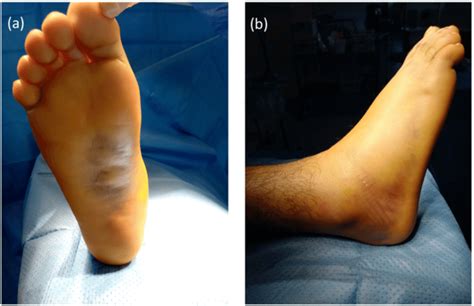 Plantar ecchymosis (a) and skin condition (b). | Download Scientific ...