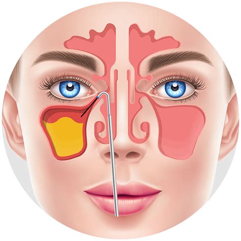 Balloon Sinuplasty for Snoring in Houston | Kaplan Sinus Relief