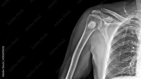 Foto de Film X ray shoulder radiograph show Enchondroma disease at arm ...