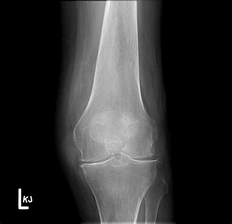 Gouty arthropathy | Image | Radiopaedia.org