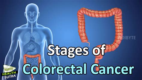 Stages of Colorectal Cancer || Health Tips - YouTube