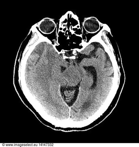 Subdural Hematoma with Herniation Subdural Hematoma with Herniation, CT ...