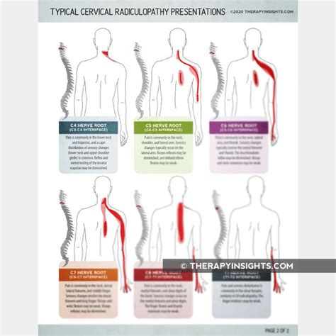 Typical Cervical Radiculopathy Presentations – Therapy Insights