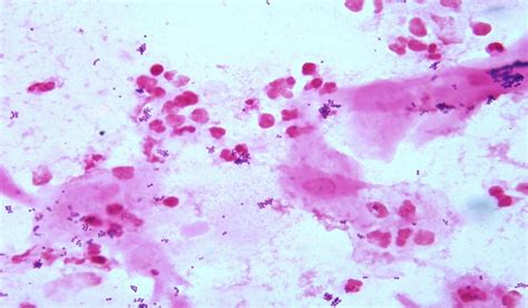 Gram stain of wound specimen | Medical Laboratories