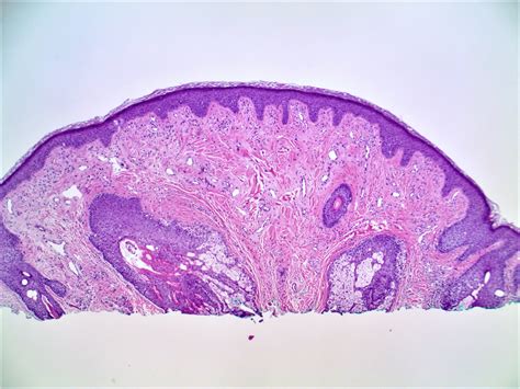 Fibrous Papule