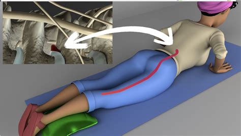 Herniated Disc Exercises