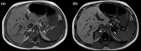 Lipid-Rich Benign Adrenal Adenoma. Axial T1-weighted MRI in-phase ...