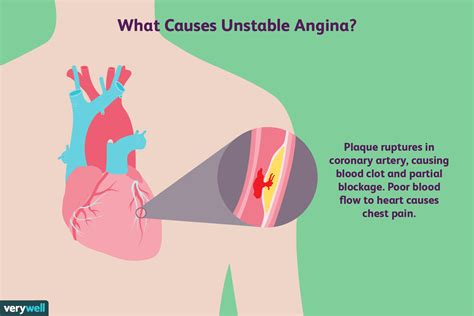 Unstable Angina: Symptoms, Causes, Diagnosis, and More
