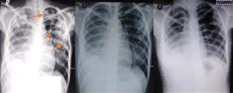 A) Chest X-ray before anti-tuberculosis therapy, showing infiltrates in... | Download Scientific ...