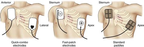 funest Poate Obraznic aed pad placement secol Bebelus alege