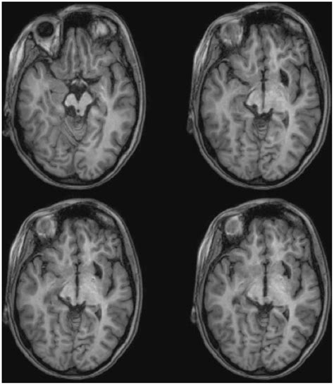 Frontiers | Deafferentation of the Superior Colliculus Abolishes ...