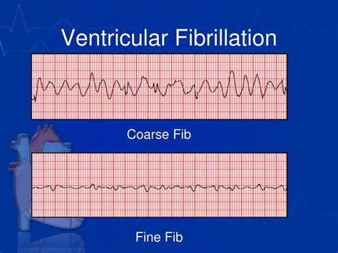 PPT - EKG Recognition for EMT’s (Part 2) PowerPoint Presentation, free download - ID:2156592