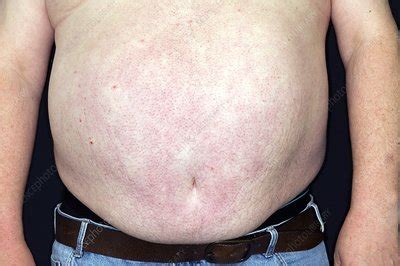 Obese abdomen in diabetes - Stock Image - C008/3625 - Science Photo Library