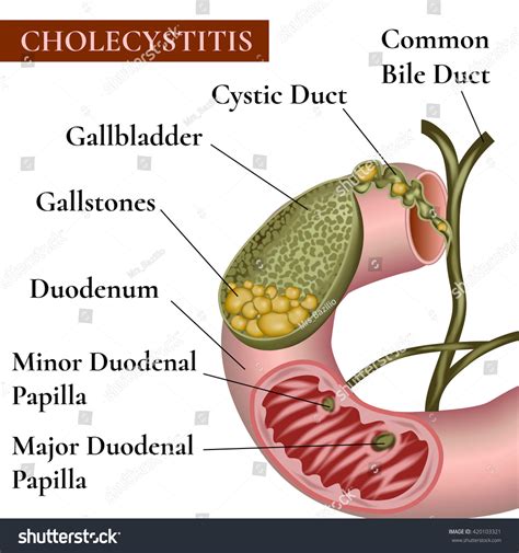 Cholecystitis. Inflammation Of The Gallbladder And Bile Ducts ...