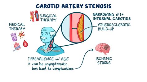 Carotid artery stenosis screening: Clinical sciences - Osmosis Video ...