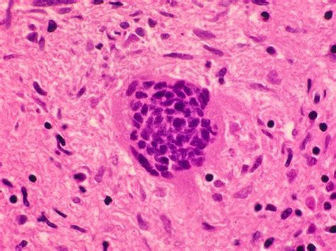 Giant multinucleated cells | Pathology Student