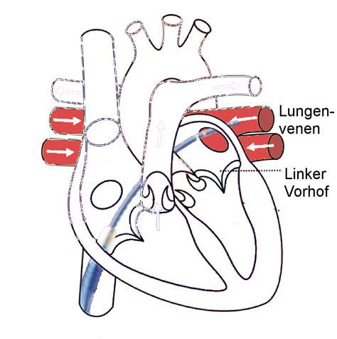 File:Herz Lungenvenenablation.png - Wikipedia