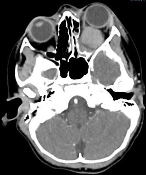 First description of a retrobulbar haemorrhage in a paediatric patient | BMJ Case Reports