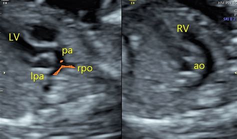 Transposition of the great arteries (TGA) - fetal echocardiogram | Image | Radiopaedia.org