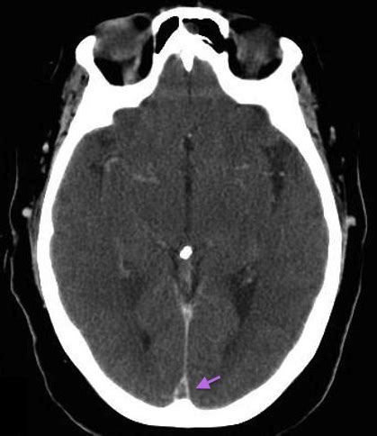 Radiology Signs • Empty delta sign - of dural venous sinus...