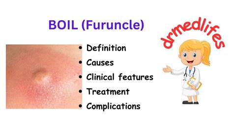 Boil furuncle definition causes clinical features treatment ...