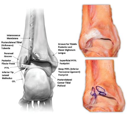 Anatomy 101: Ankle Syndesmosis - Distal Tibiofibular Joint — Rayner & Smale