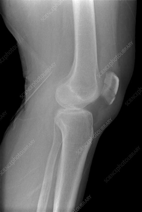 Broken knee, X-ray - Stock Image - C010/3498 - Science Photo Library