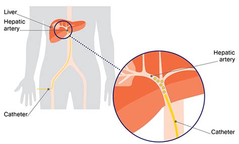 cuscús Desconfianza Descendencia transarterial chemoembolization tace Inconveniencia regular ...