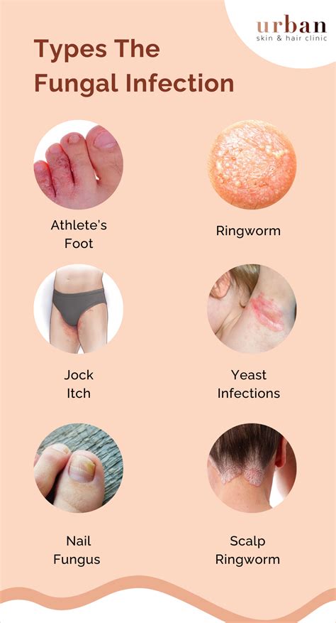 Fungal Infection Types, Causes, Symptoms & Treatment | USHC