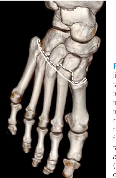 Figure 1 from Modified Lisfranc Amputation to Reduce Hematoma Rate in ...