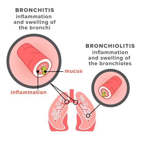 Bronchitis Symptoms